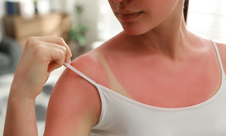 how to heal sunburnt skin fast